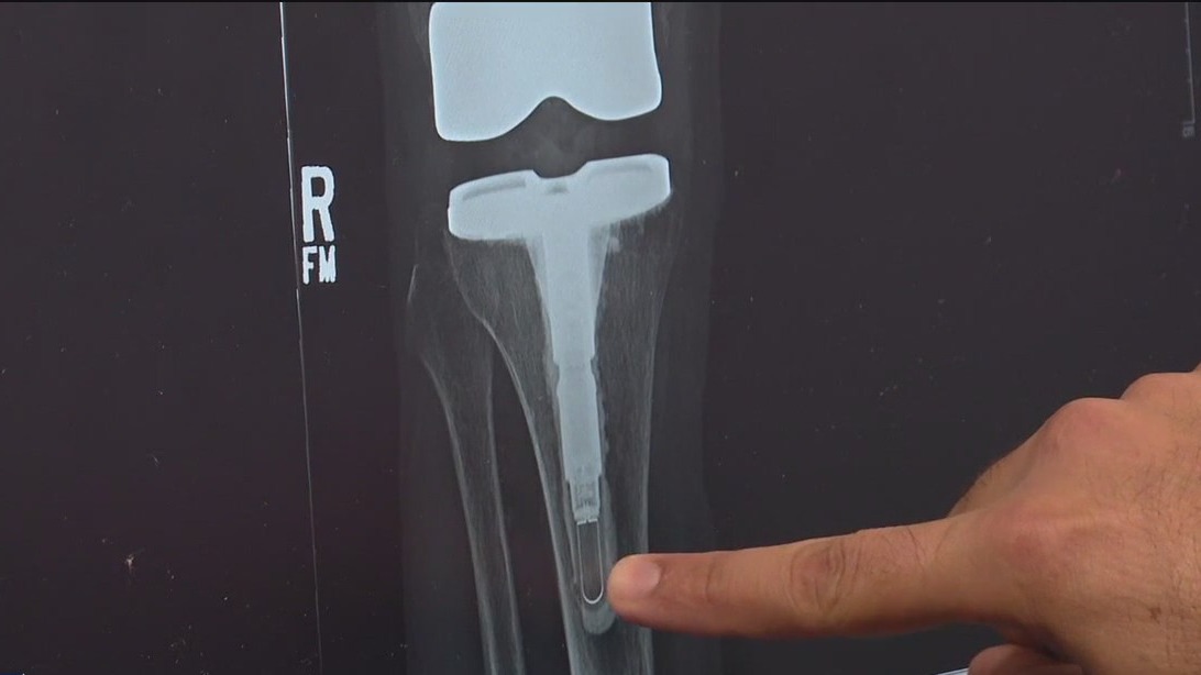 'Smart Knee' could change future of knee replacements